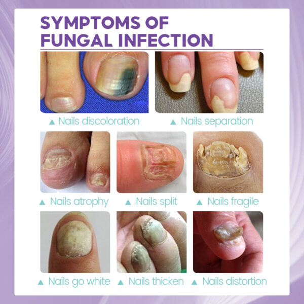 ⁦• NAIL FANGUS SPRAY⁩ - الصورة ⁦11⁩